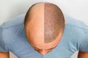 hair-transplant-in-saudi-arabia-saudi