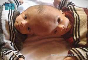 yemeni-conjoined-twins-yousuf-and-yassin-to-fly-to-riyadh-under-king-salmans-orders-for-medical-examination_UAE