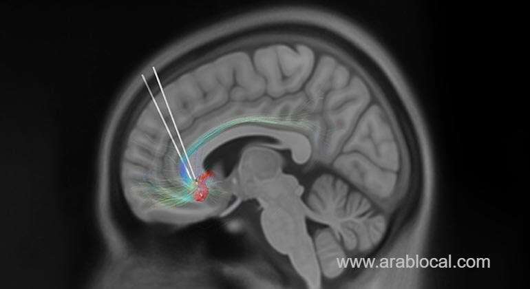 in-saudi-arabia-the-first-brain-surgery-to-treat-depression-has-been-successful-saudi