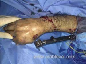 doctors-in-saudi-arabia-reattached-a-worker's-right-hand-after-freak-accident_saudi