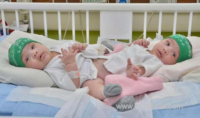 saudi-siamese-twins-to-be-separated-on-thursday-saudi