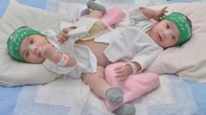 surgery-to-separate-saudi-conjoined-twins-postponed_UAE