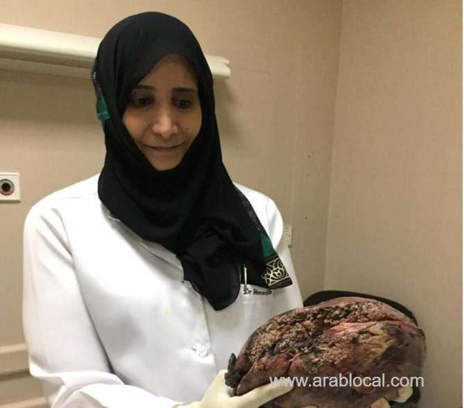 saudi-female-surgeon-leads-operation-to-remove-rare-liver-tumor-saudi