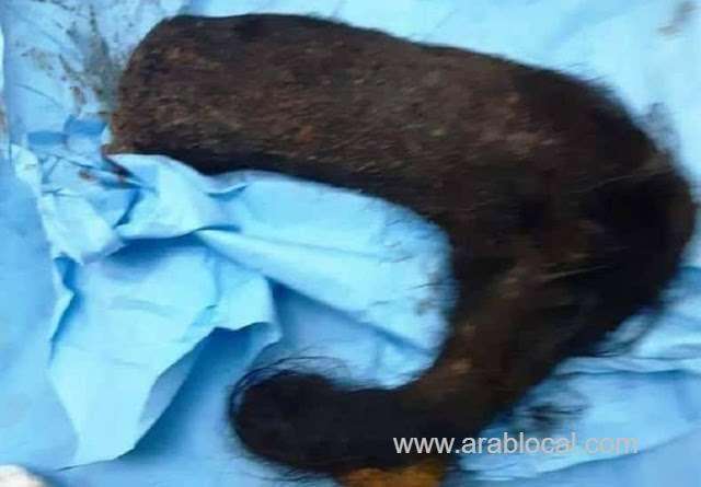 2-kg-of-hair-extacted-from-the-young-womans-stomach-in-taif-saudi